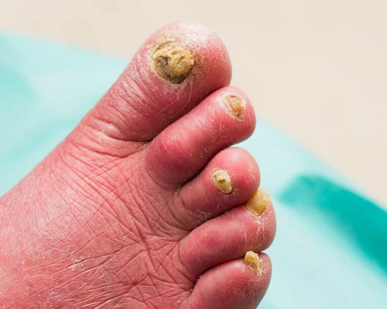 Onychomycosis tünetei