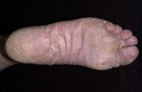 A gomba jelei és tünetei a lábakon