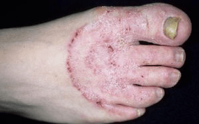 A gomba megjelenésének okai a lábakon