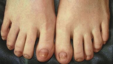 A körömgomba fejlesztésének szakaszai