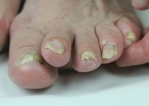 körömgomba kezelése gyógyszerekkel