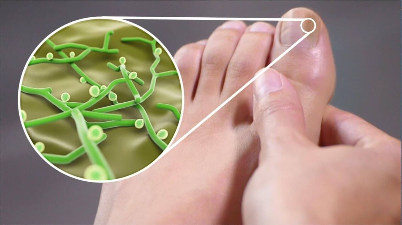 körömgomba kórokozói