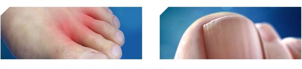 a lábgomba kezdeti szakasza